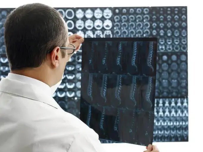 X-rays for Back Pain Low Back Pain X-Ray Findings