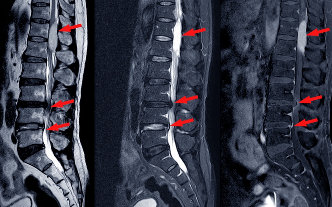 What Is a Bulging Disc vs. a Herniated Disc? Understanding the Difference